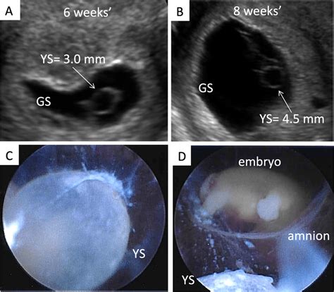 can an enlarged yolk sac correct itself|The human yolk sac size reflects involvement in .